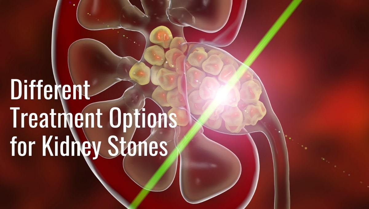 What are the different treatment options for kidney stones according to Dr. Samuel Lawindy?