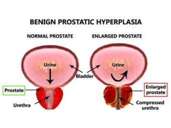 Benign Prostatic Hyperplasia